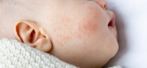 Las manchas en el recién nacido, tipos de manchas y cuando acudir al médico